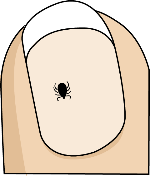 Illustration of an unfed tick on a human fingernail to show scale.